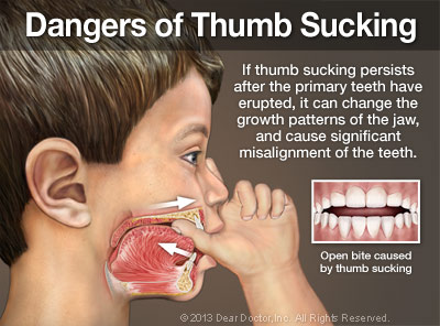 Dangers of Thumb Sucking.