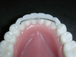 Fixed (Bonded) Retainers